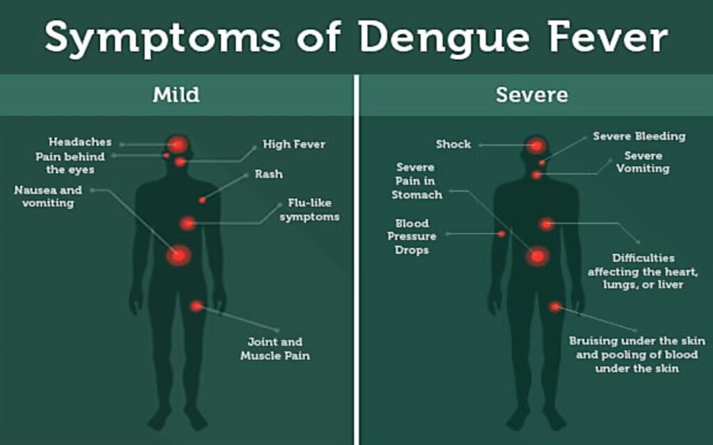 Symptoms of Dengue Fever