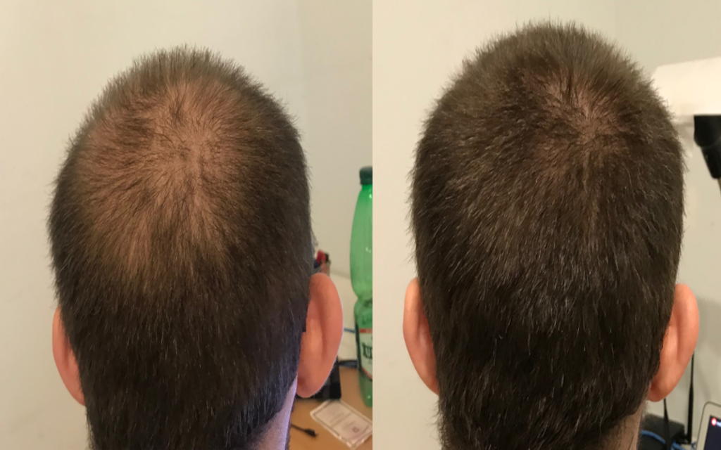 How does Minoxidil Work for Hair Growth?